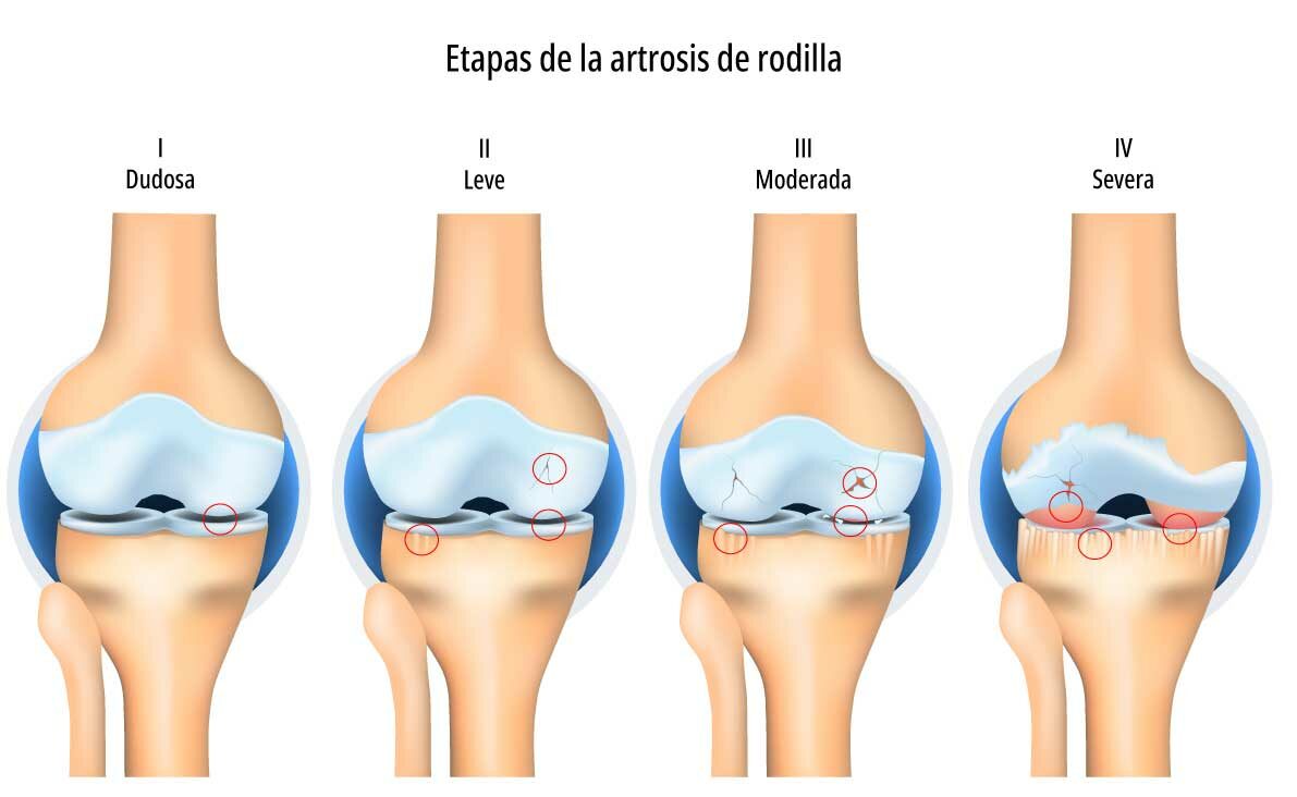 Grados de Artrosis de rodilla